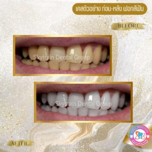 ฟอกสีฟัน (7)