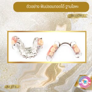 ฟันปลอมแบบถอดได้ (8)