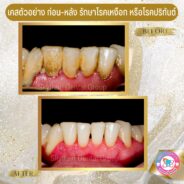 รักษาโรคเหงือก-โรคปริทันต์ (2)