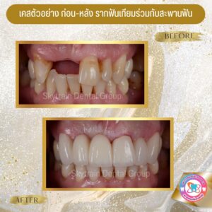 รากฟันเทียม (1)