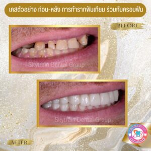 รากฟันเทียม (7)