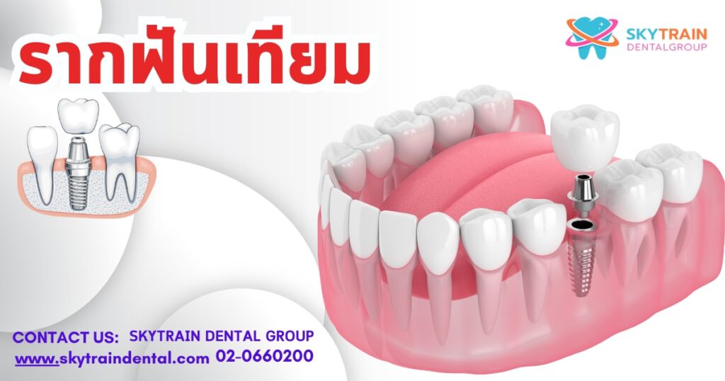 รากฟันเทียม ราคาเท่าไหร่