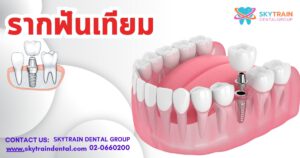 รากฟันเทียม ราคาเท่าไหร่