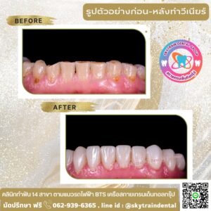 วีเนียร์ (10)