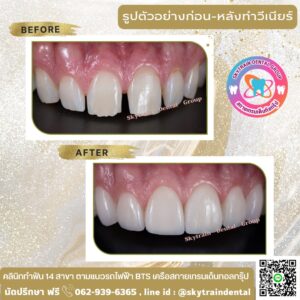 วีเนียร์ (16)