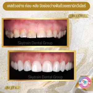 วีเนียร์ (25)