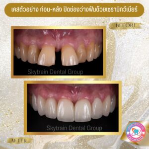 วีเนียร์ (30)