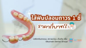 ใส่ฟันปลอมถาวร 1 ซี่ ราคากี่บาท