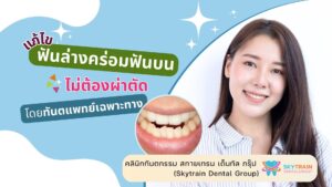[รวม] วิธีแก้ไขฟันล่างคร่อมฟันบน แบบไม่ต้องผ่าตัด