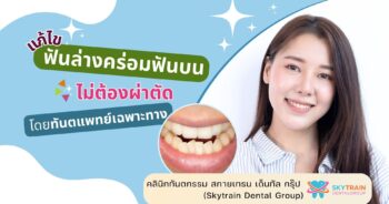 ฟันล่างคร่อมฟันบน