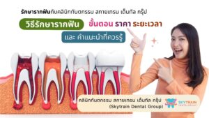 วิธีรักษารากฟัน – ขั้นตอน ราคา ระยะเวลา และ คำแนะนำที่ควรรู้