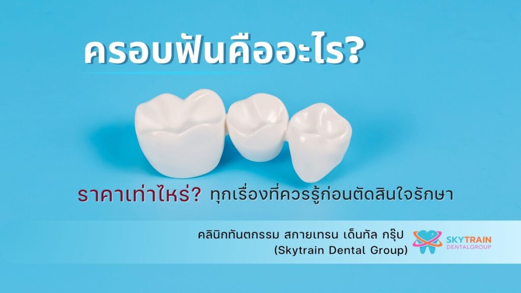 ครอบฟันคืออะไร? ราคาเท่าไหร่? ข้อควรรู้ก่อนตัดสินใจรักษา