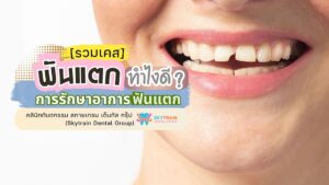 [รวมเคส] ฟันแตก ทำไงดี ? การรักษาอาการฟันแตก