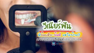 วีเนียร์ฟัน มีข้อเสีย-ข้อดี อะไรบ้าง? เปรียบเทียบ วีเนียร์แต่ละประเภท