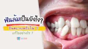 ฟันล้มคืออะไร? อันตรายหรือไม่? และแก้ไขอย่างไร?