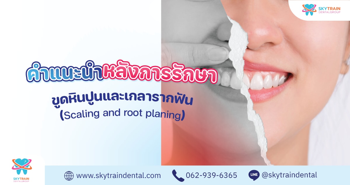 หลังขูดหินปูน และเกลารากฟัน