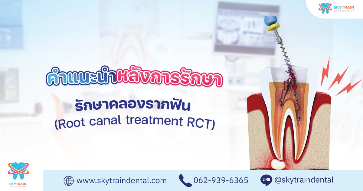 คู่มือหลังรักษารากฟัน