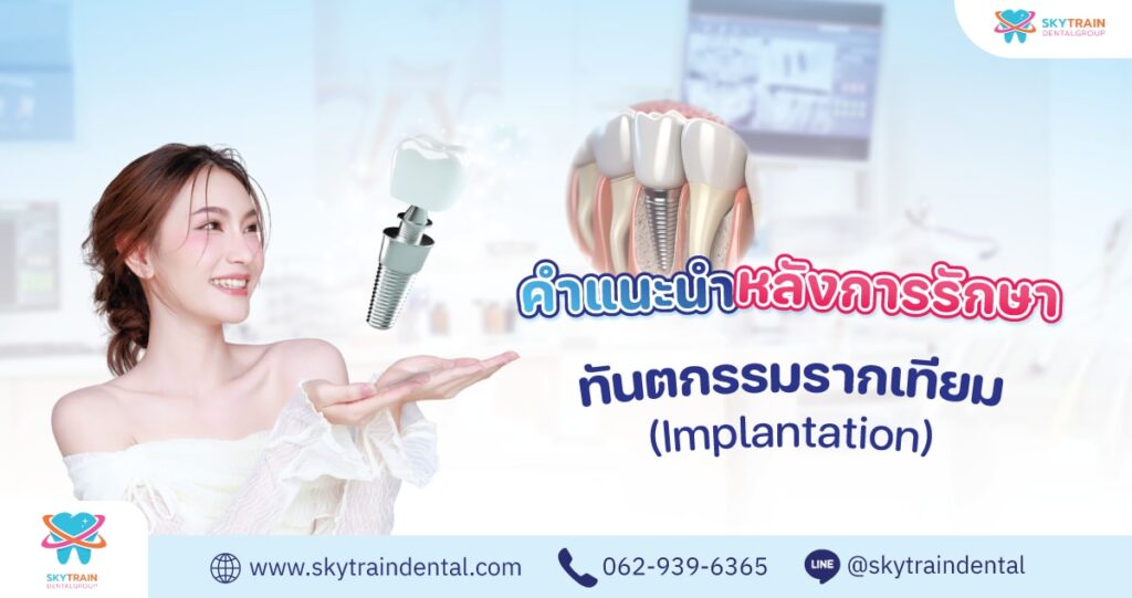 คู่มือดูแลตัวเองหลังฝังรากเทียม (ตั้งแต่ปักรากถึงใส่ครอบ)