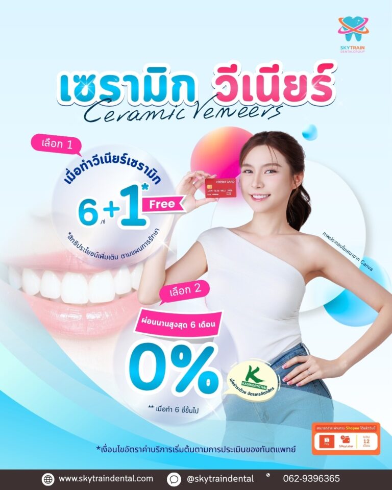 เซรามิกวีเนียร์