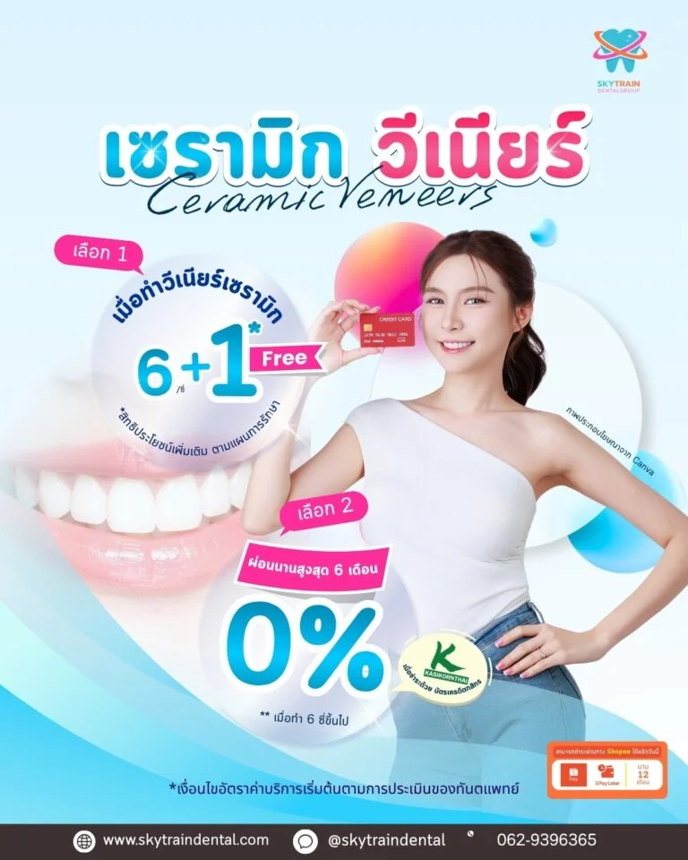 เซรามิกวีเนียร์
