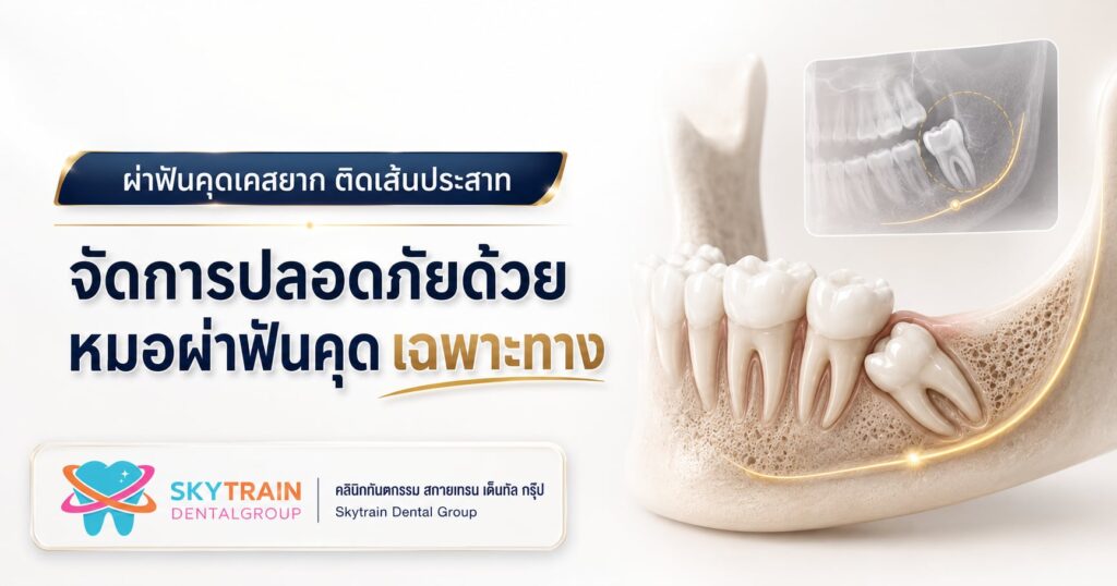 ผ่าฟันคุดเคสยาก ติดเส้นประสาท จัดการอย่างไรให้ปลอดภัย?