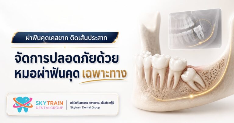 ผ่าฟันคุดเคสยาก ติดเส้นประสาท จัดการอย่างไรให้ปลอดภัย?